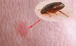 Gros plan d'une piqure de puce sur la peau humaine, avec une puce visible dans un médaillon.