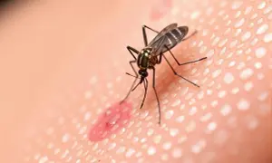 Moustique sur une peau irritée, une piqûre rouge et gonflée. Le vinaigre pourrait soulager cette piqûre de moustique.