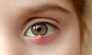 Un œil avec un orgelet rouge et gonflé sur la paupière inférieure, ressemblant à de petits boutons blancs.