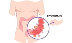 Illustration de la diverticulite, montrant des diverticules dans le côlon. Attention aux aliments à éviter.