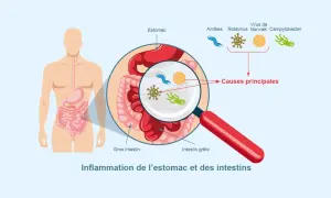 Illustration montrant l'inflammation de l'estomac et des intestins, avec des microbes comme causes principales. Comprendre comment se transmet la gastro est essentiel.