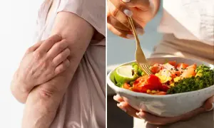 Bras irrités par le psoriasis, à côté d'une assiette colorée. L'alimentation peut influencer le psoriasis.