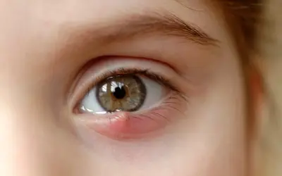 Un œil avec un orgelet rouge et gonflé sur la paupière inférieure, ressemblant à de petits boutons blancs.