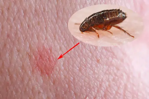 Gros plan d'une piqure de puce sur la peau humaine, avec une puce visible dans un médaillon.