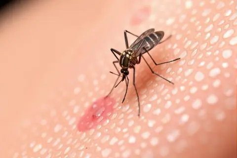 Moustique sur une peau irritée, une piqûre rouge et gonflée. Le vinaigre pourrait soulager cette piqûre de moustique.