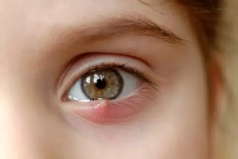 Un œil avec un orgelet rouge et gonflé sur la paupière inférieure, ressemblant à de petits boutons blancs.