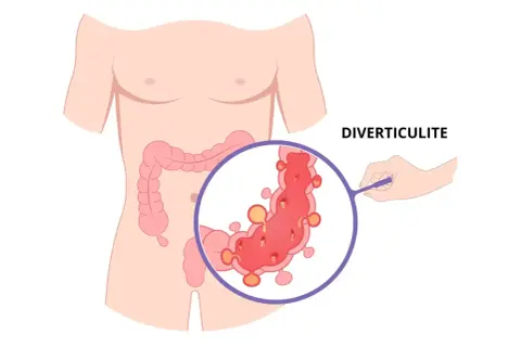 Illustration de la diverticulite, montrant des diverticules dans le côlon. Attention aux aliments à éviter.