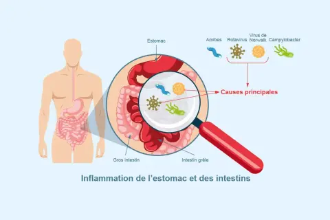 Illustration montrant l'inflammation de l'estomac et des intestins, avec des microbes comme causes principales. Comprendre comment se transmet la gastro est essentiel.