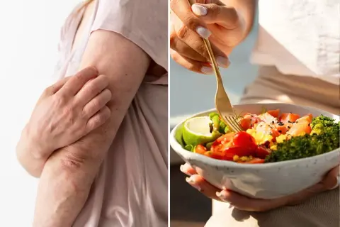 Bras irrités par le psoriasis, à côté d'une assiette colorée. L'alimentation peut influencer le psoriasis.