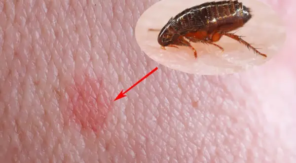 Gros plan d'une piqure de puce sur la peau humaine, avec une puce visible dans un médaillon.
