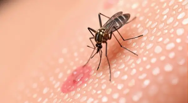 Moustique sur une peau irritée, une piqûre rouge et gonflée. Le vinaigre pourrait soulager cette piqûre de moustique.
