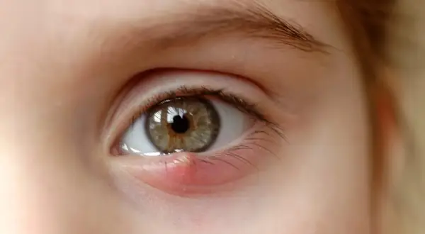 Un œil avec un orgelet rouge et gonflé sur la paupière inférieure, ressemblant à de petits boutons blancs.