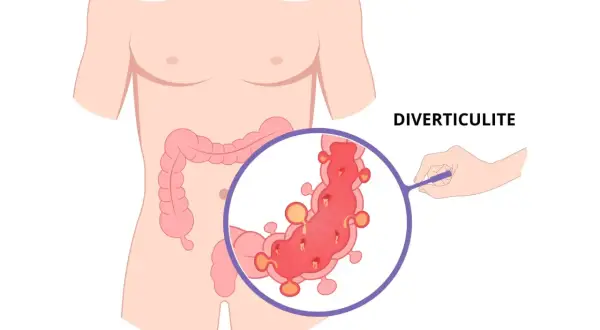 Illustration de la diverticulite, montrant des diverticules dans le côlon. Attention aux aliments à éviter.