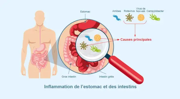 Illustration montrant l'inflammation de l'estomac et des intestins, avec des microbes comme causes principales. Comprendre comment se transmet la gastro est essentiel.