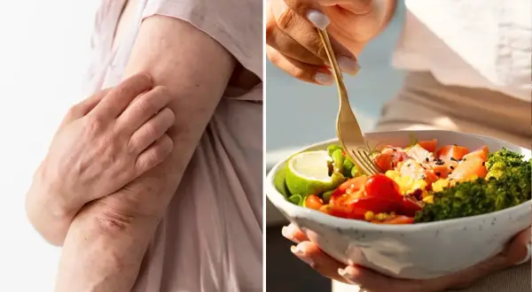 Bras irrités par le psoriasis, à côté d'une assiette colorée. L'alimentation peut influencer le psoriasis.