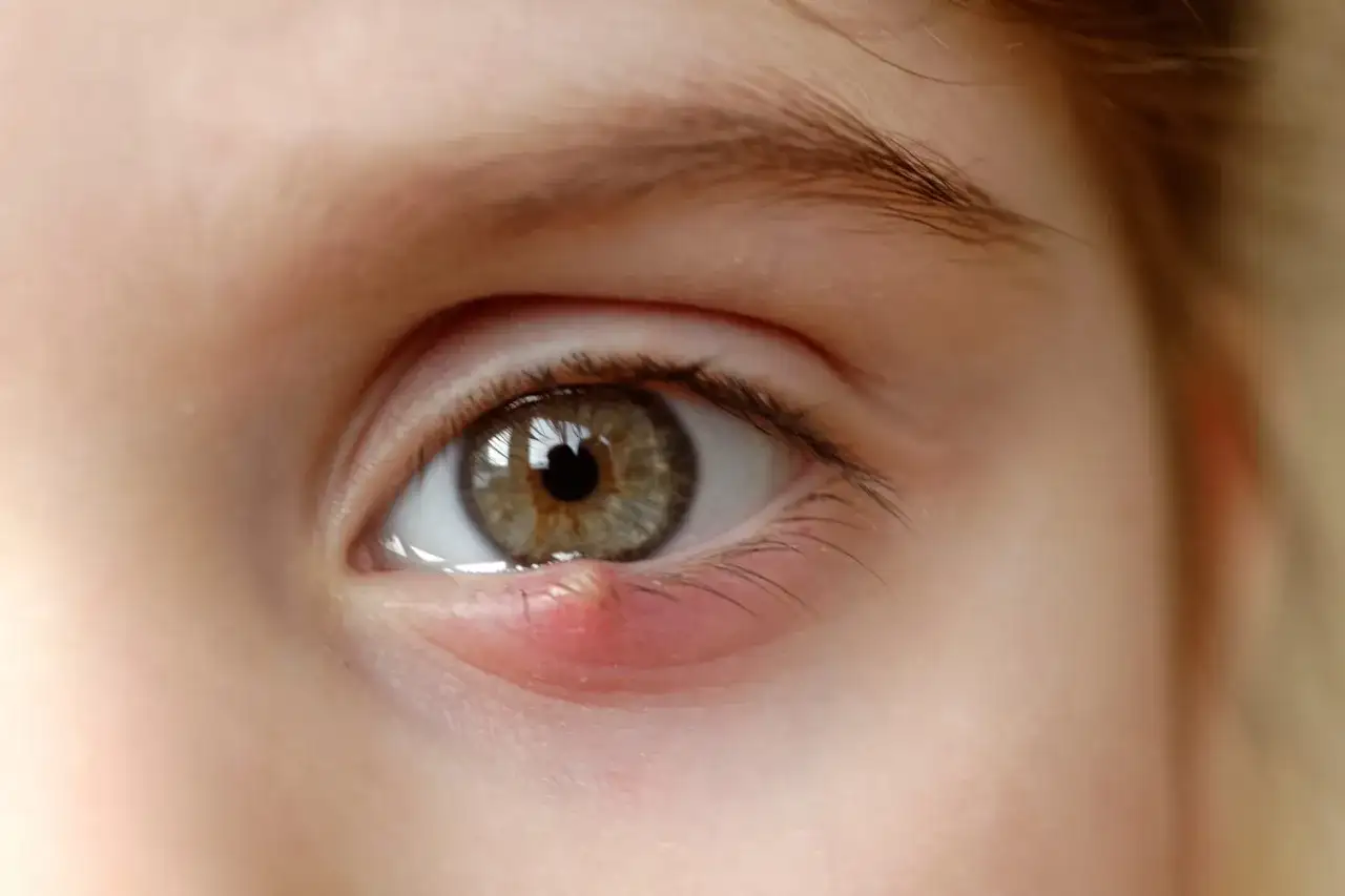 Un œil avec un orgelet rouge et gonflé sur la paupière inférieure, ressemblant à de petits boutons blancs.