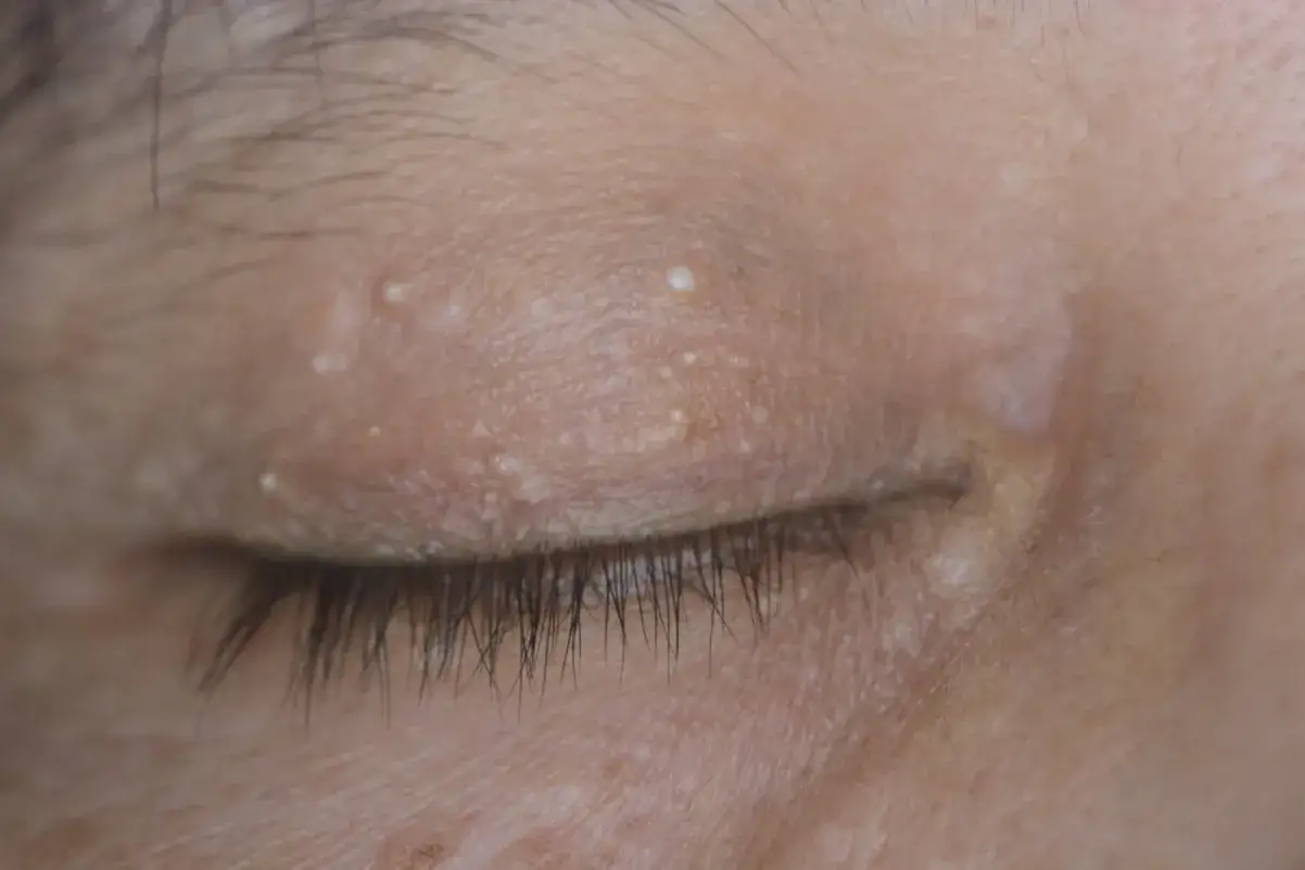 Petits boutons blancs sur les paupières, près des cils. La peau semble légèrement texturée.