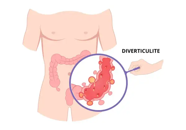 Illustration de la diverticulite, montrant des diverticules dans le côlon. Attention aux aliments à éviter.
