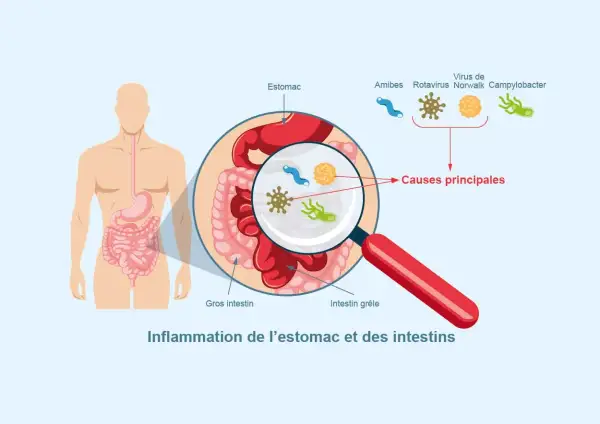 Illustration montrant l'inflammation de l'estomac et des intestins, avec des microbes comme causes principales. Comprendre comment se transmet la gastro est essentiel.
