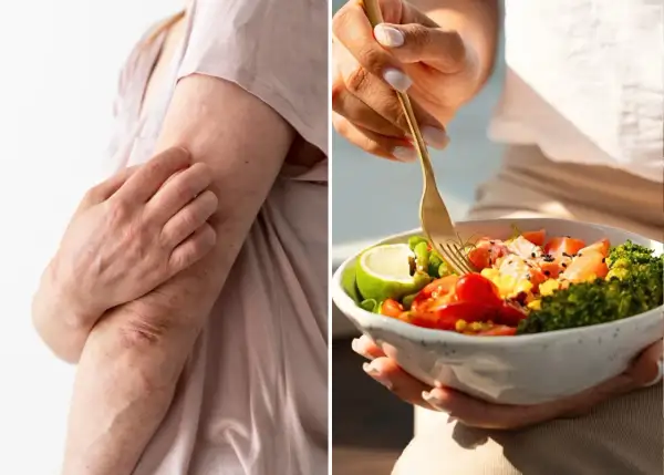 Bras irrités par le psoriasis, à côté d'une assiette colorée. L'alimentation peut influencer le psoriasis.
